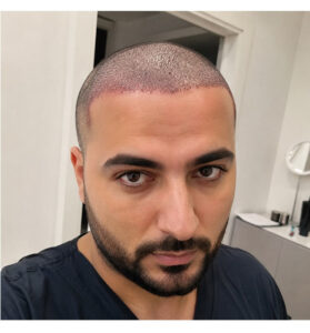 کاشت مو